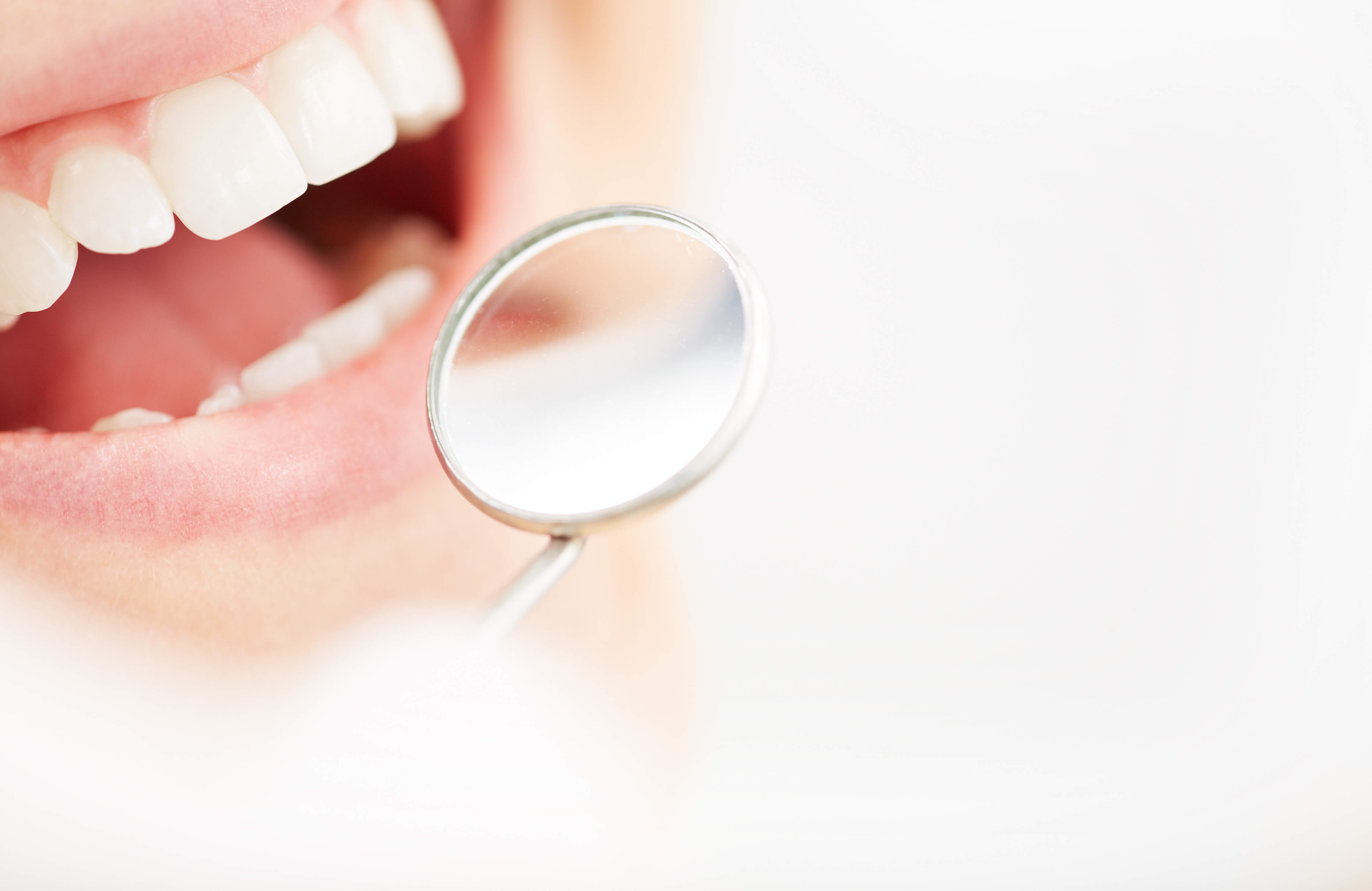 veneers